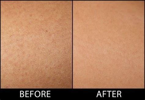 How To Get Rid Of Keratosis Pilaris Or Chicken Skin For Good