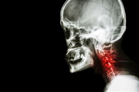 Cervical spondylosis is a very common disorder. Cervical spondylosis . film x-ray skull lateral view and ...