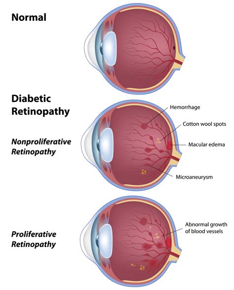 Diabetic Retinopathy Petrou Eye Care