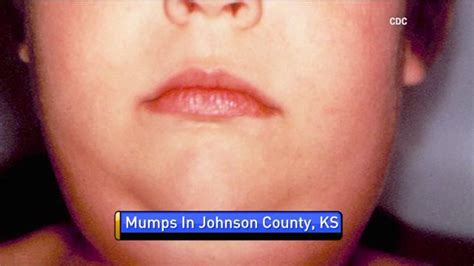Health Officials Confirm New Mumps Case In Johnson County Fox 4