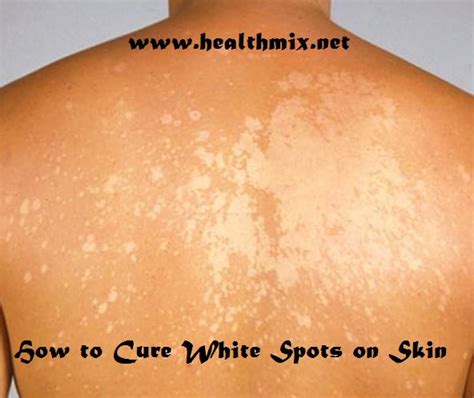 How To Cure White Spots On Skin Healthmix Info