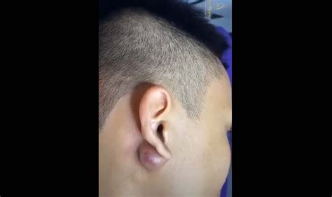 Huge Cyst Behind Right Ear Drained New Pimple Popping Videos
