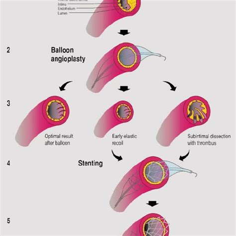Schematic Diagram Of The Primary Mechanisms Of Balloon Angioplasty And