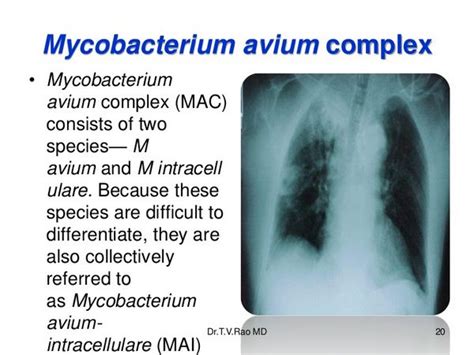 Mycobacterium Avium Complex Disseminated And Pulmonary Disease