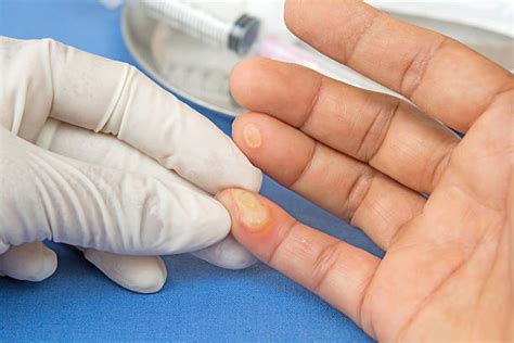 Burn Blister Pictures Images And Stock Photos Istock