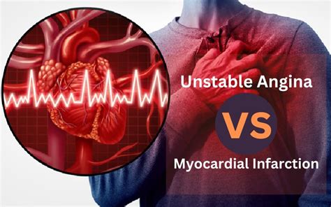 13 Amazing Facts About Difference Between Unstable Angina And