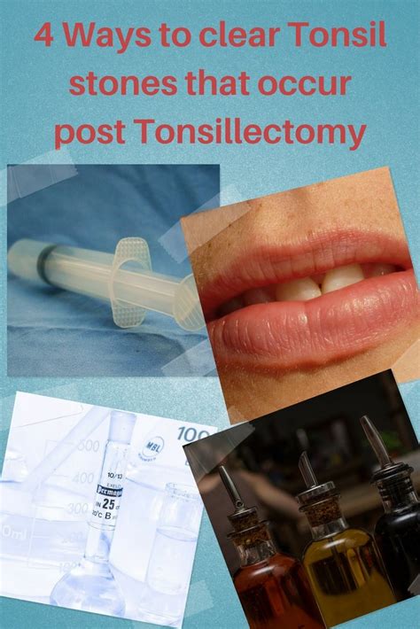 Removing Tonsil Stones Formed Post Tonsillectomy Without Tonsils