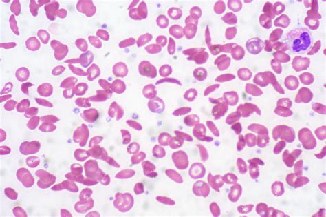 Whats Causing Heart Complications In Sickle Cell Anemia Pat Cardiology