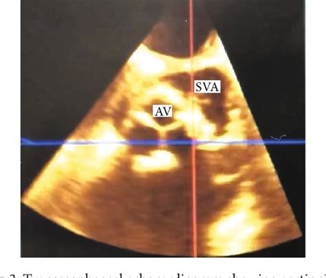 Figure 1 From An Unusual Case Of An Acquired Aortopulmonary Fistula