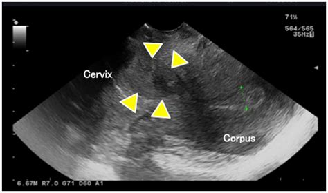 Does Cervical Cancer Show Up On An Ultrasound ️updated