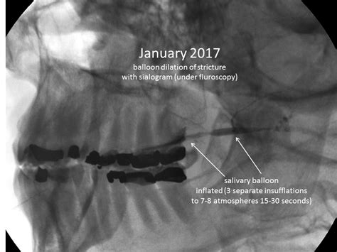 Parotid Duct Stricture Sialoballon Dilation With Fluoroscopy And