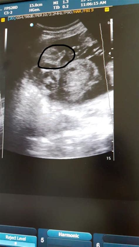 Melalui usg, dokter dan ibu hamil dapat mengetahui kondisi janin dalam kandungan. 24+ Gambar Usg 2 Dimensi Bayi Laki Laki - Richi Wallpaper