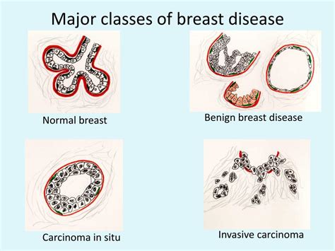Ppt Breast Pathology Powerpoint Presentation Free Download Id6724137