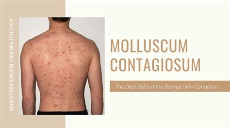 Molluscum Contagiosum The Deal Behind Raising Bumps On Skin