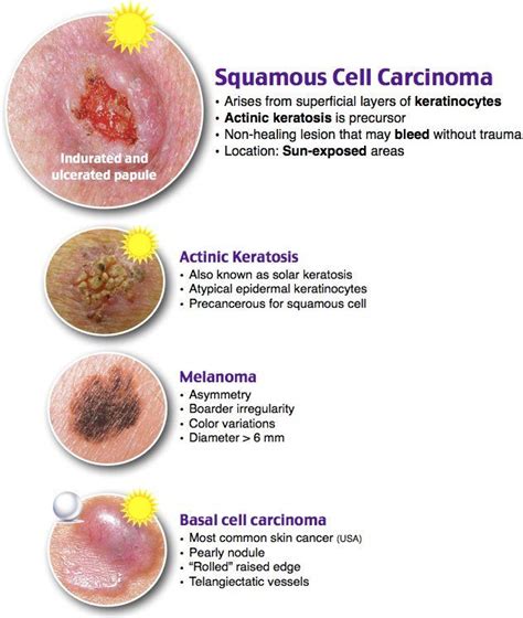 Basal Cell Carcinoma Vs Squamous Cell Carcinoma Jaylenewadougherty