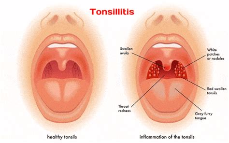 White Spot Patches On Tonsils Causes Symptoms Treatment