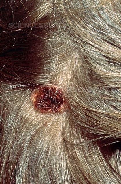 Photograph Basal Cell Carcinoma Scalp Science Source Images