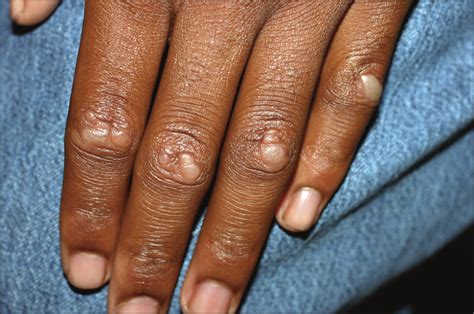 Papules Overlying The Finger Joints—quiz Case Dermatology Jama