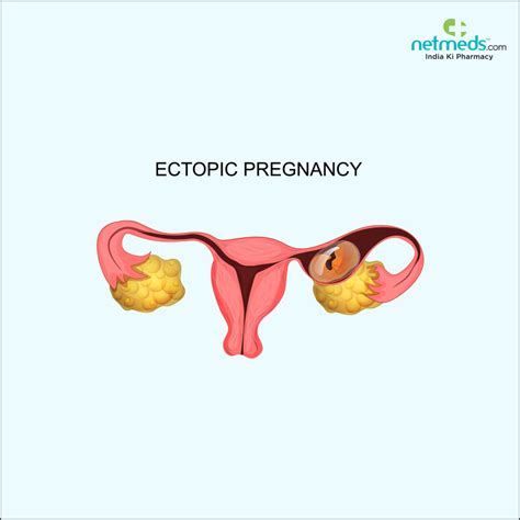 Ectopic Pregnancy Can Affect In Pregnancies