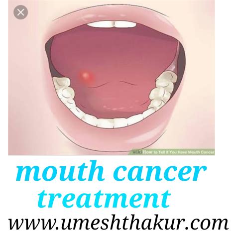 Mouth Cancer Symptoms Remedies To Avoid Oral Cancer Reason And Home