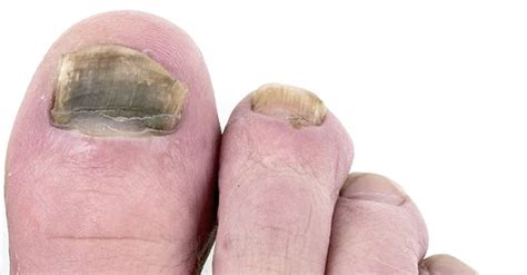 Nail Skin And Face Fungal Infection And Symptoms Premier Clinic