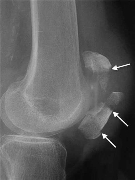 Patellar Fractures Broken Kneecap Orthoinfo Aaos