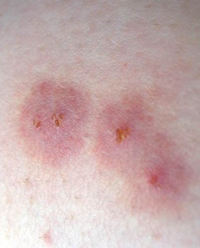 Itchy Bumps On Skin Like Mosquito Bites Sea Lice That Nasty Rash You