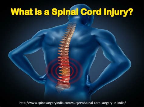 Ppt What Is A Spinal Cord Injury Powerpoint Presentation Free