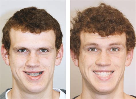 Facial Asymmetry Due To Occlusion How To Fix