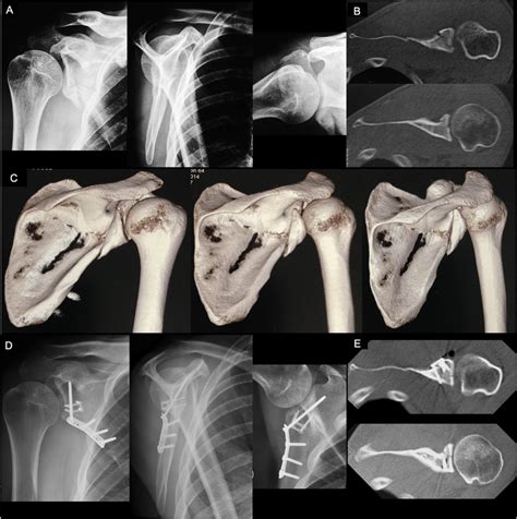A Preoperative True Ap Lateral Scapular And Axillary Radiographic