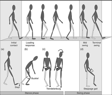 What Are The Different Types Of Abnormal Gait Abnormal Body Systems Images