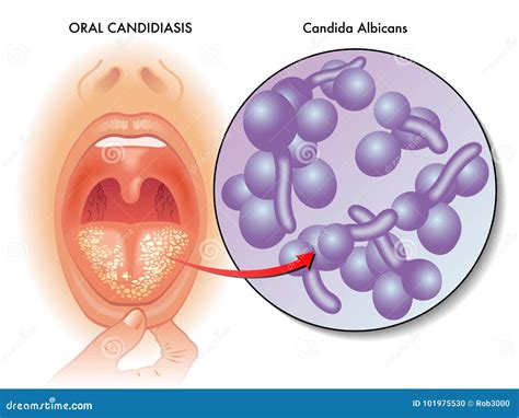 Medical Illustration Of Oral Candidiasis Stock Vector Illustration Of Macro Oral