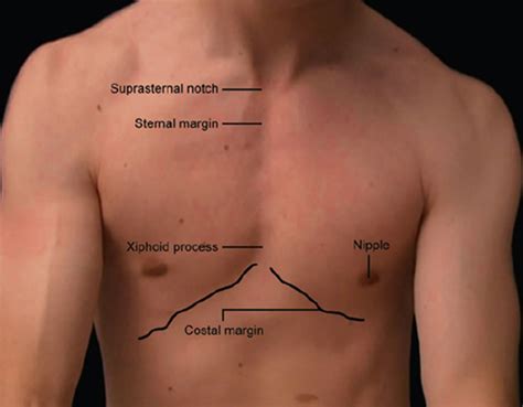 Inverted Xiphoid Process