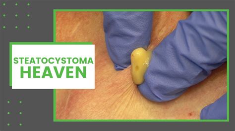 Steatocystoma Heaven Dr Derm Youtube
