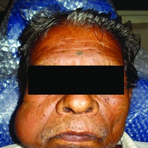 Front View Of The Face Showing Diffuse Swelling On The Right Side