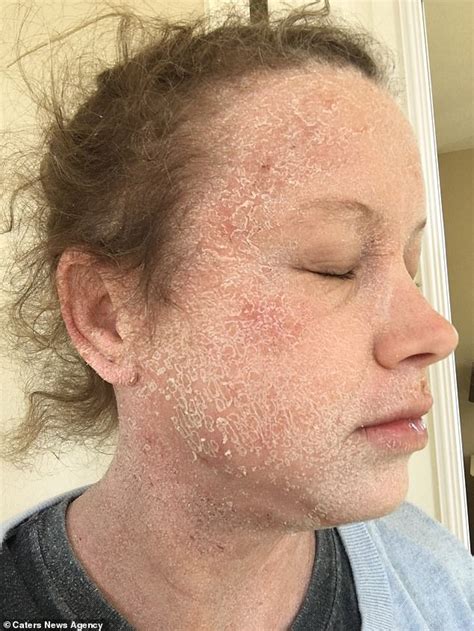 Mother Of Two Claims To Have Reversed Her Severe Eczema With A Vegan