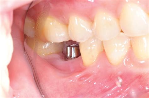 New Treatment For Jaw Osteonecrosis Around Dental Implants Bite Magazine