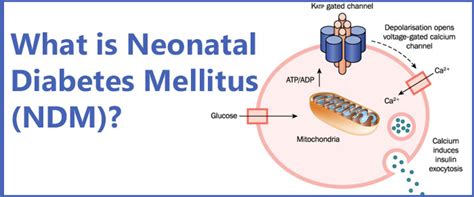 What Is Neonatal Diabetes Mellitus Ndm Dr Mohans Diabetes