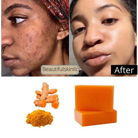 Turmeric Kojic Bar Soap Dark Spots Remover Acne Remover Etsy Skin