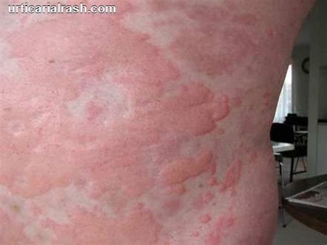 Red Rashes On Skin Pictures Photos