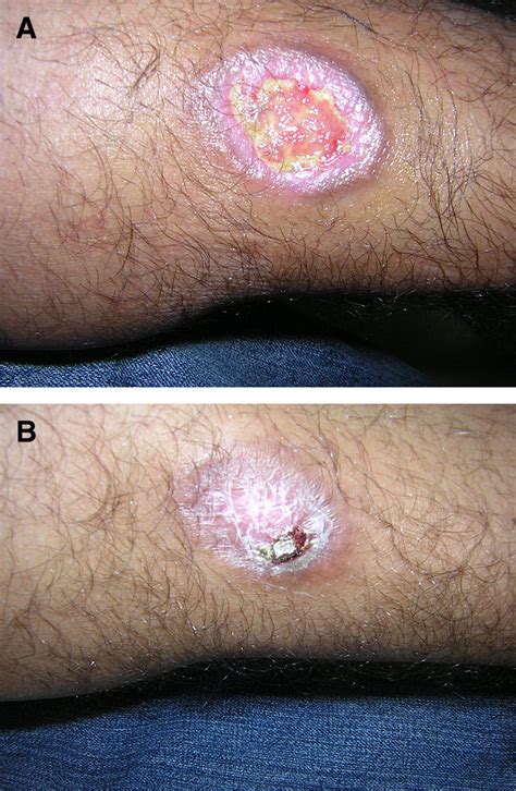 Nontuberculous Mycobacterial Infections Of The Skin A Retrospective
