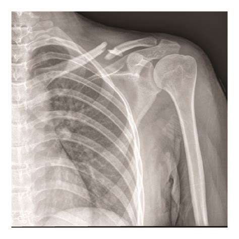 A Left Closed Comminuted Midshaft Clavicle Fracture B Fracture End