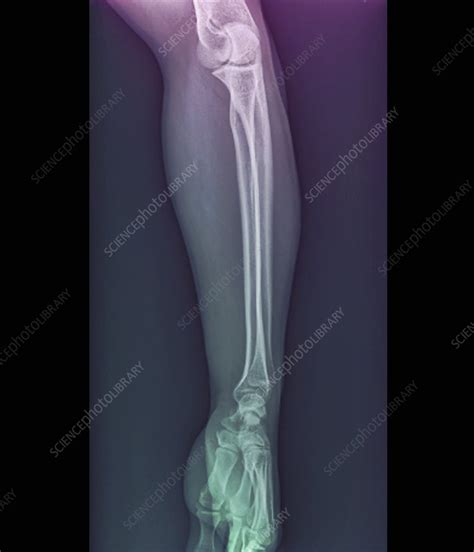 Normal Elbow And Wrist Joints X Ray Stock Image F0027551