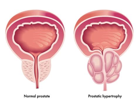 Urodynamics In Benign Prostatic Hyperplasia Bph Patients