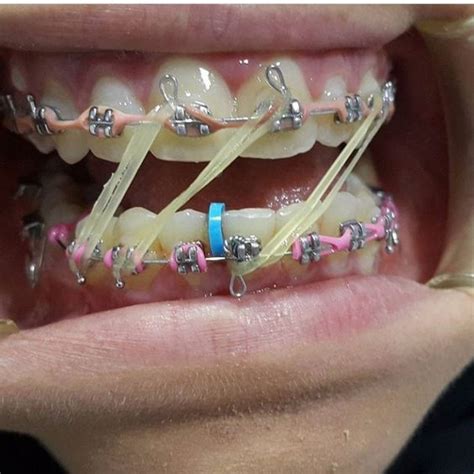 Pin By Elpotrillo31 On Mouth Braces Dental Braces Metal Braces