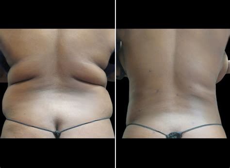 Liposuction For Women Before And After NYC Lipo Results