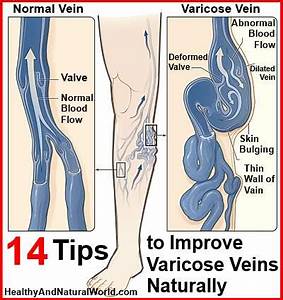 14 Tips to Improve Varicose Veins Naturally  Heart and Circulation Varicose Veins