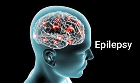 What Are The Causes Symptoms And Diagnosis Of Epilepsy