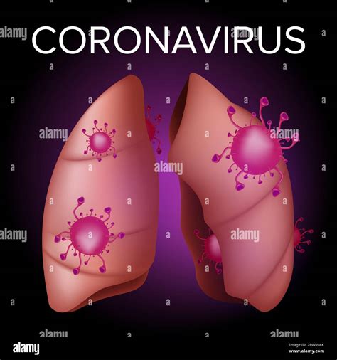 Pulmones humanos con сoronavirus nCoV infección respiratoria en Oriente Medio Ilustración