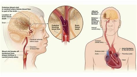 Difference Between Stroke And Tia Signs And Symptoms Causes Risk Otosection